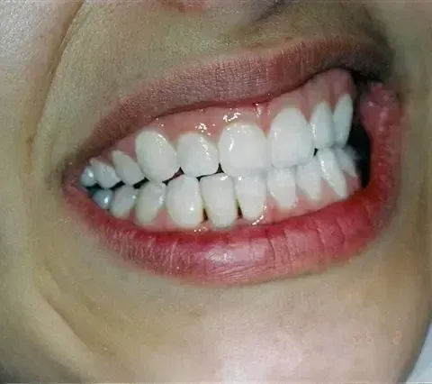 Close-up of a smiling mouth showing bright white teeth and pink lips