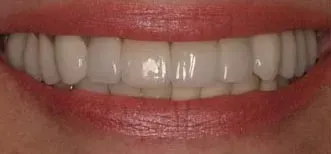 Close-up of a smiling mouth with white teeth and pink lips