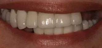 Close-up of a smiling mouth with white teeth and red lipstick