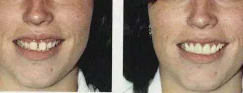 Side-by-side close-up of a smiling mouth, showing before-and-after dental alignment changes.