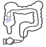Kidney stone, urinary stone, ureteric stone, renal calculi, renal colic, nephrolithiasis