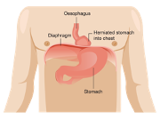 Kidney stone, urinary stone, ureteric stone, renal calculi, renal colic, nephrolithiasis