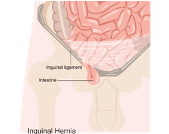 Kidney stone, urinary stone, ureteric stone, renal calculi, renal colic, nephrolithiasis
