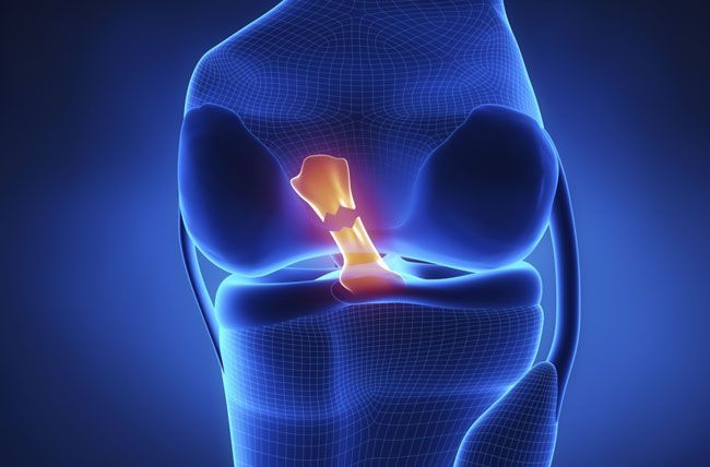 A computer generated image of a knee with a broken kneecap.