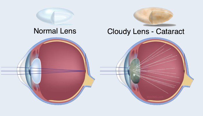 Diagram of eye with normal lens vs. cloudy lens. Light passes clearly through normal eye, is scattered by cataract.