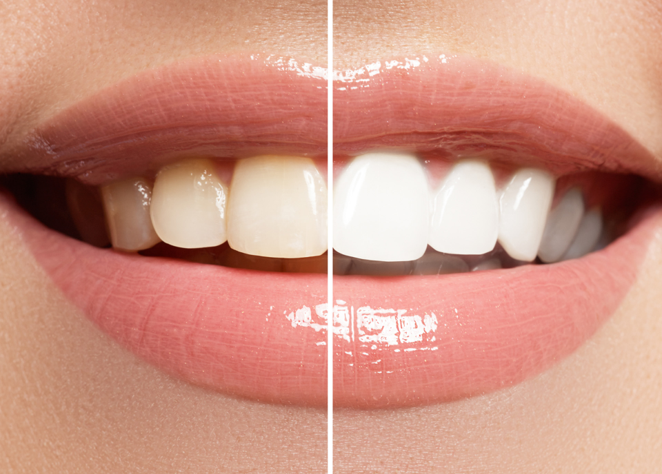 Before and after teeth whitening comparison.