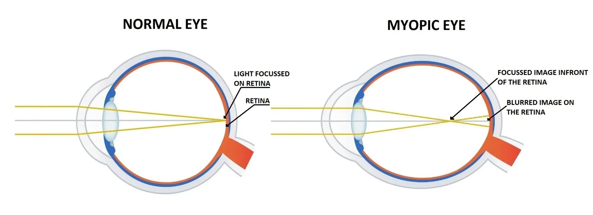 A diagram of a normal eye and a myopic eye