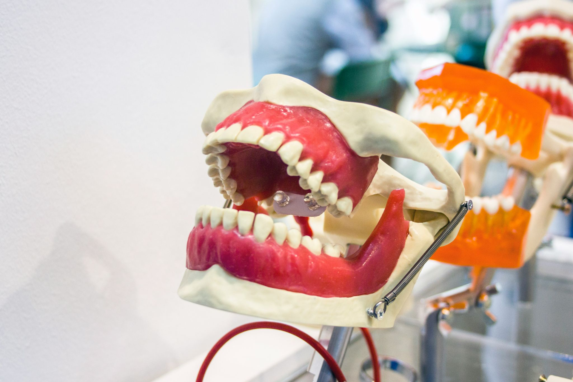 Dental implants and dentures
