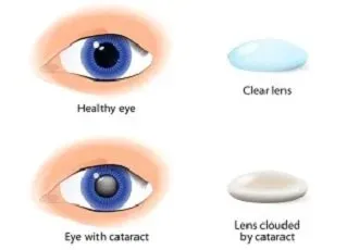 Cataract Illustration — Russellville, AR — Lieblong Eye Clinic