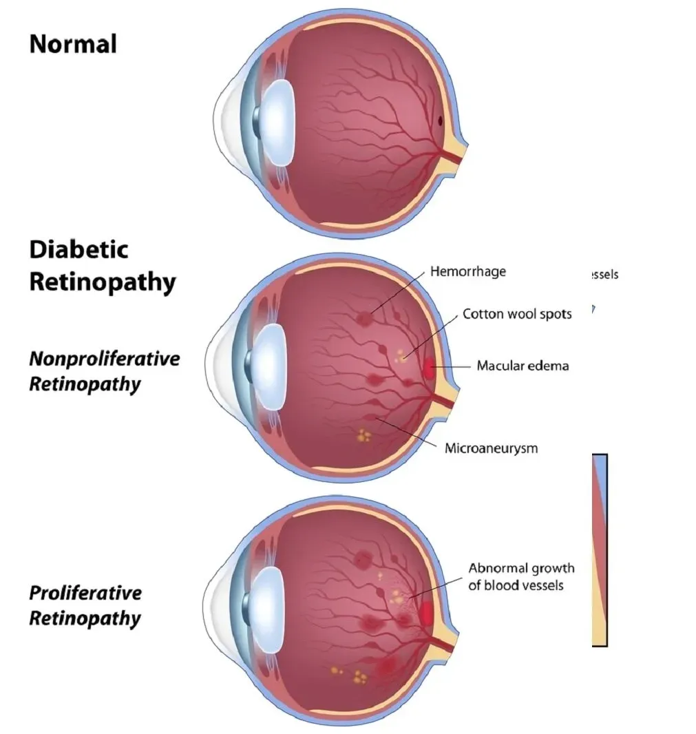 Diabetic Retinopathy — Russellville, AR — Lieblong Eye Clinic