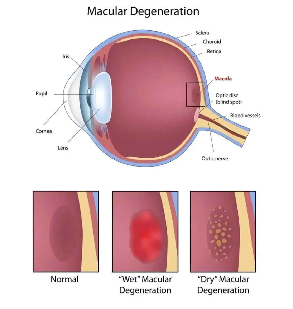 Macular Degeneration — Russellville, AR — Lieblong Eye Clinic