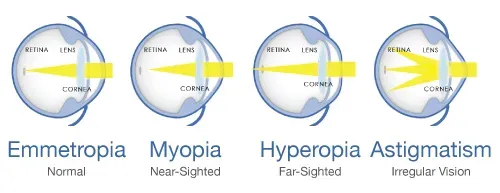 Refractive Errors — Russellville, AR — Lieblong Eye Clinic