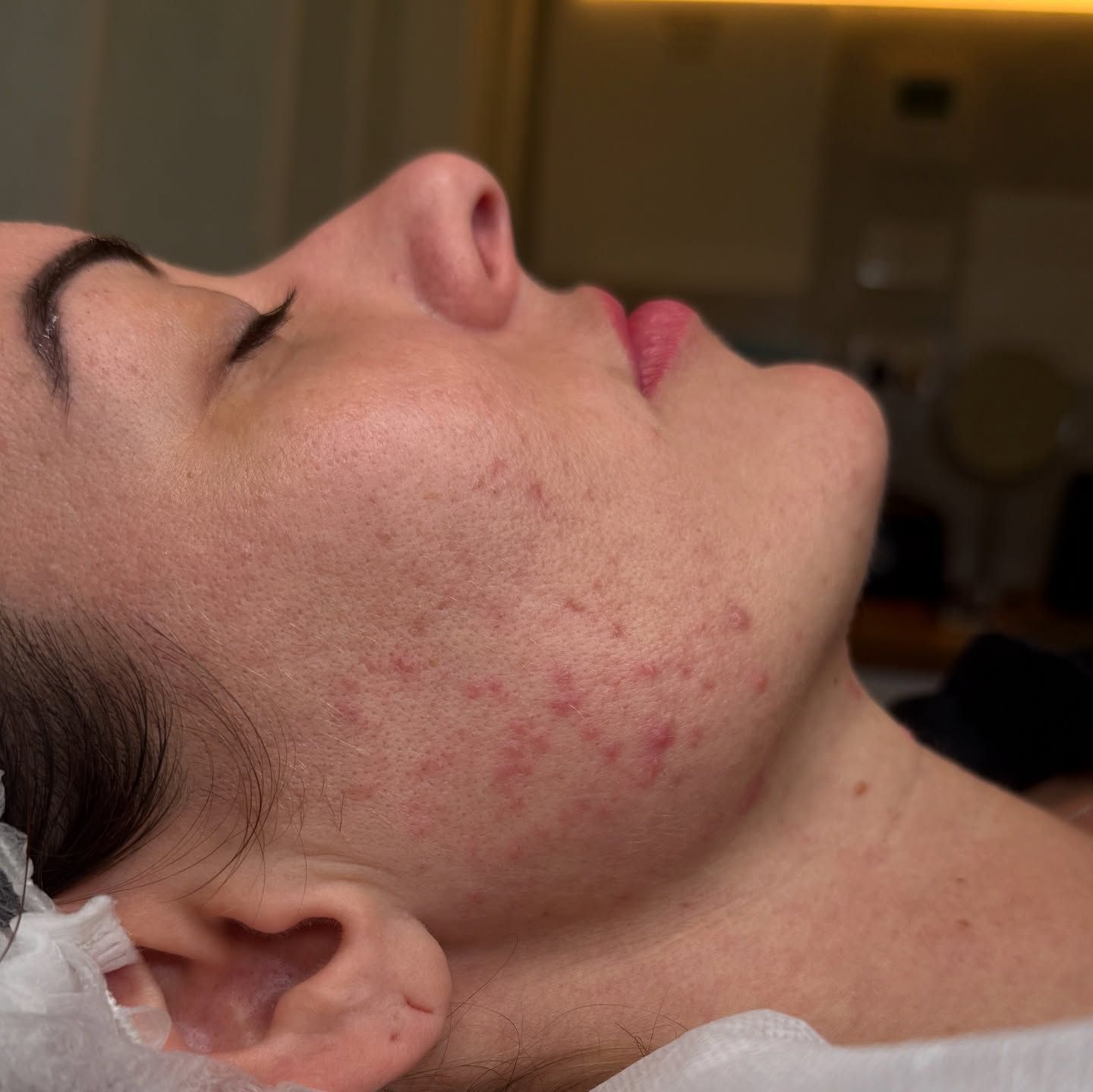 Woman with closed eyes, side profile. Skin shows red spots, likely acne. In a treatment setting.