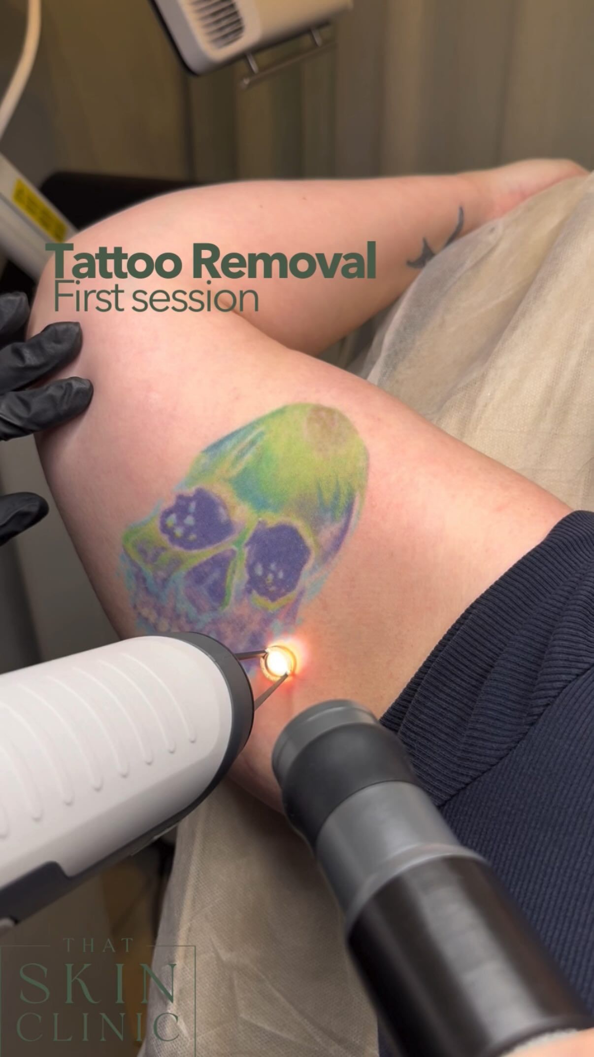 Tattoo removal comparison: Before image shows blue tattoo, after seven sessions shows faded skin.