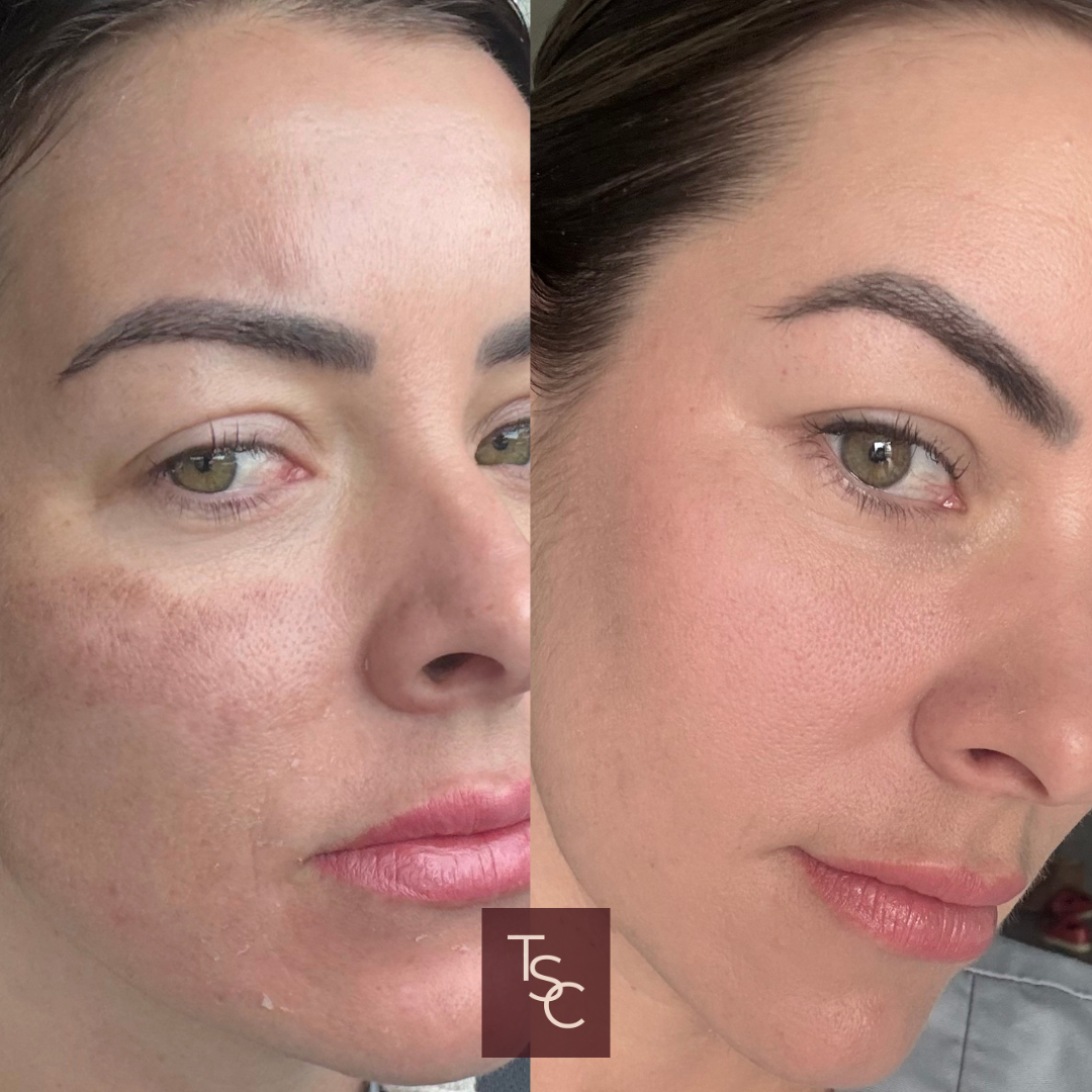 Side-by-side Close-up of a Woman’s Face Before and After Skin Treatment — That Skin Clinic in Mooloolaba, QLD