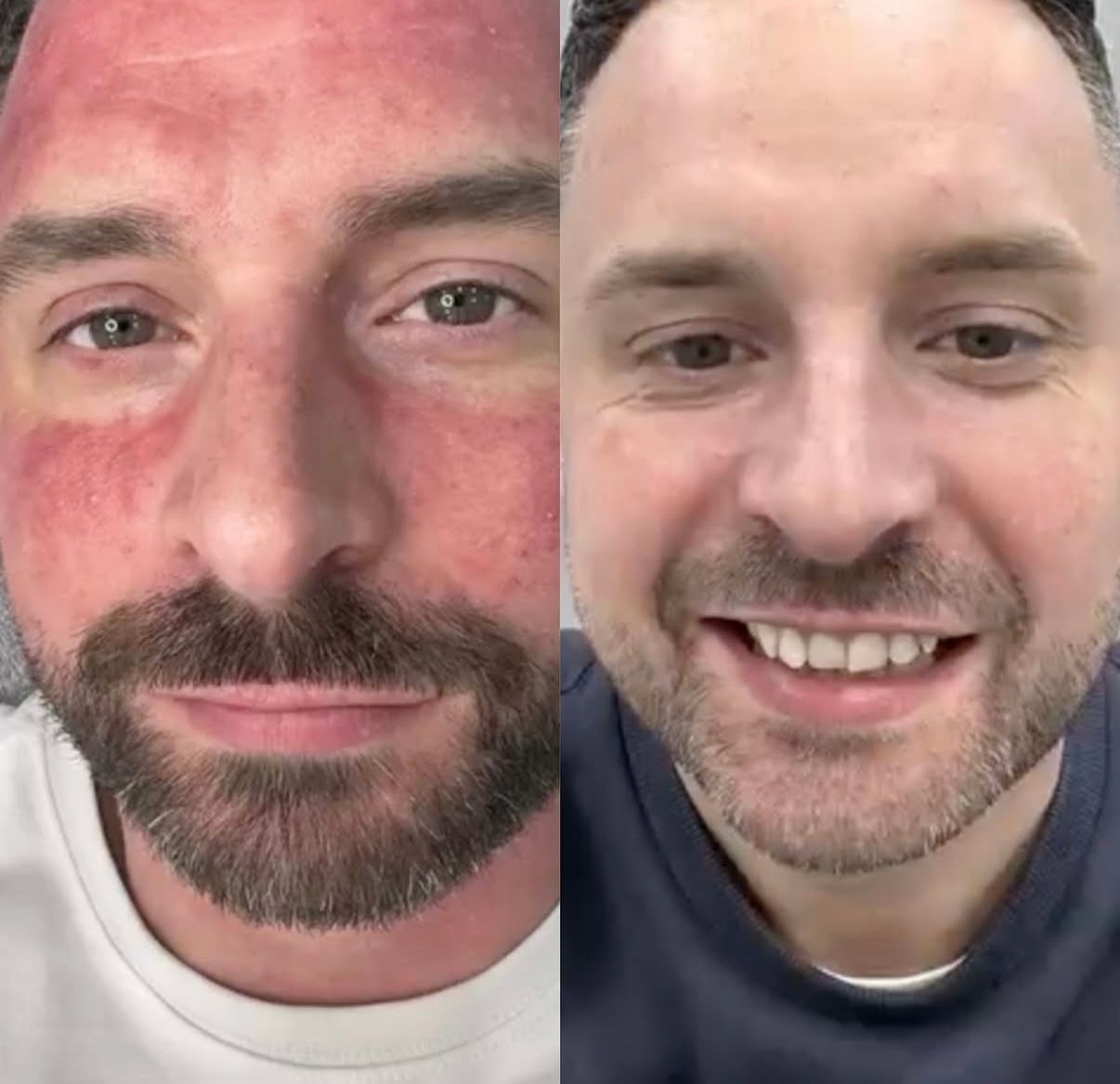 Before and After of a Smiling Men in a Close-up Selfie — That Skin Clinic in Mooloolaba, QLD