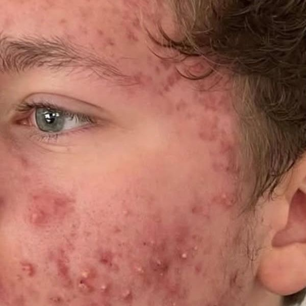 Person's Skin With Acne — That Skin Clinic in Mooloolaba, QLD