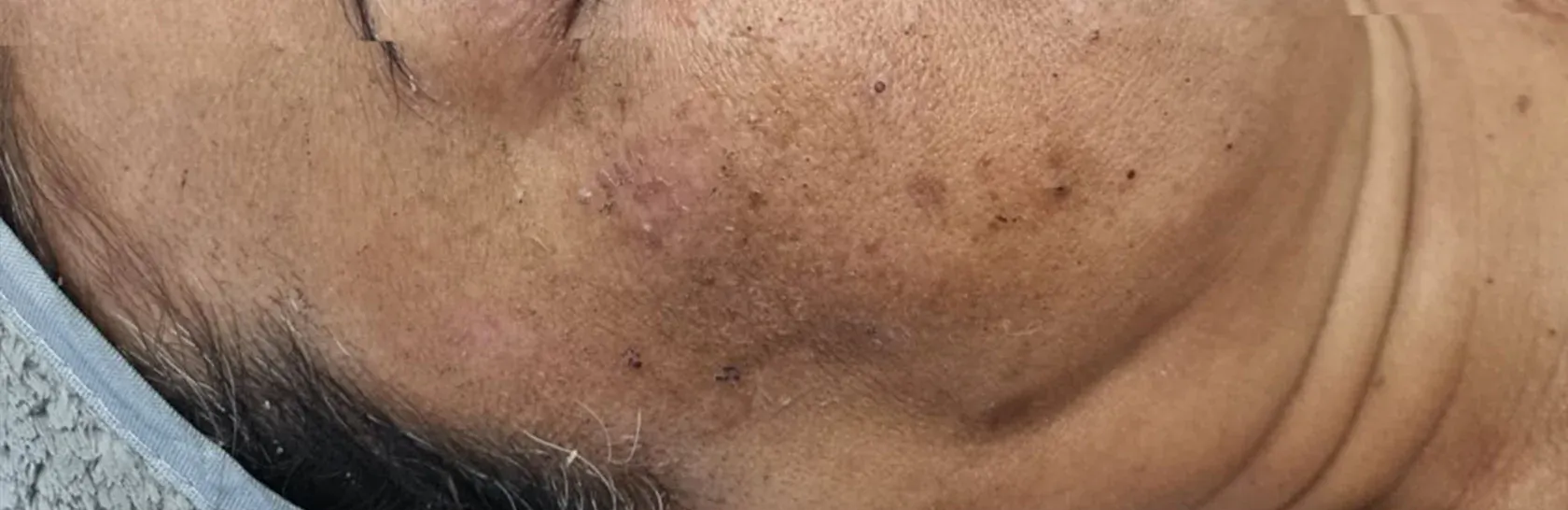 Skin Pigmentation Caused By Sun Damage — That Skin Clinic in Mooloolaba, QLD