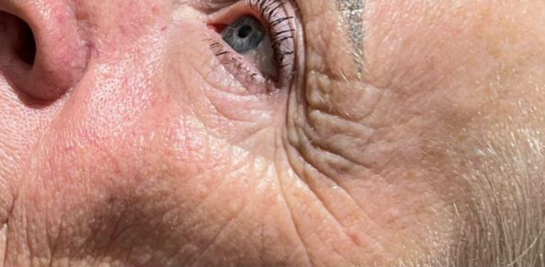 Ageing Skin With Wrinkles — That Skin Clinic in Mooloolaba, QLD