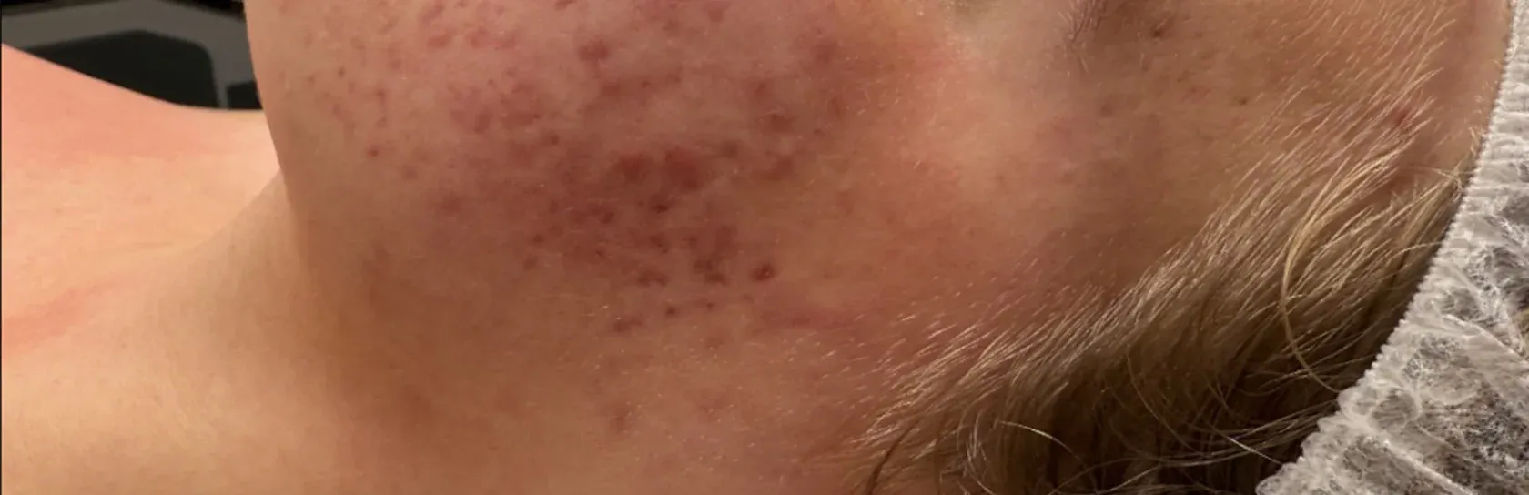 Skin Appears Irritated, With Multiple Small Reddish Spots — That Skin Clinic in Mooloolaba, QLD