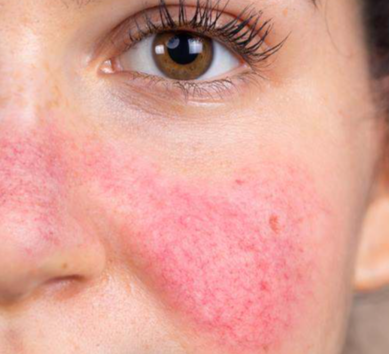 A Person Suffering From Rosacea With Red Cheeks — That Skin Clinic in Mooloolaba, QLD
