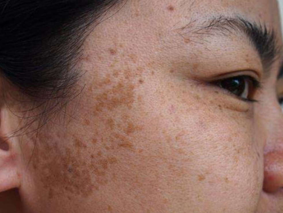 Skin Suffering From Melasma — That Skin Clinic in Mooloolaba, QLD