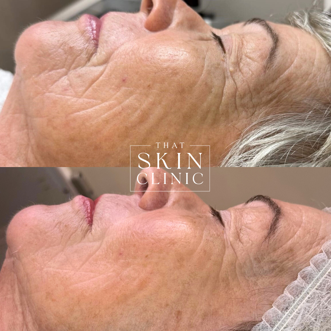 Side-profile of a Person With Eyes Closed During a Facial Treatment — That Skin Clinic in Mooloolaba, QLD