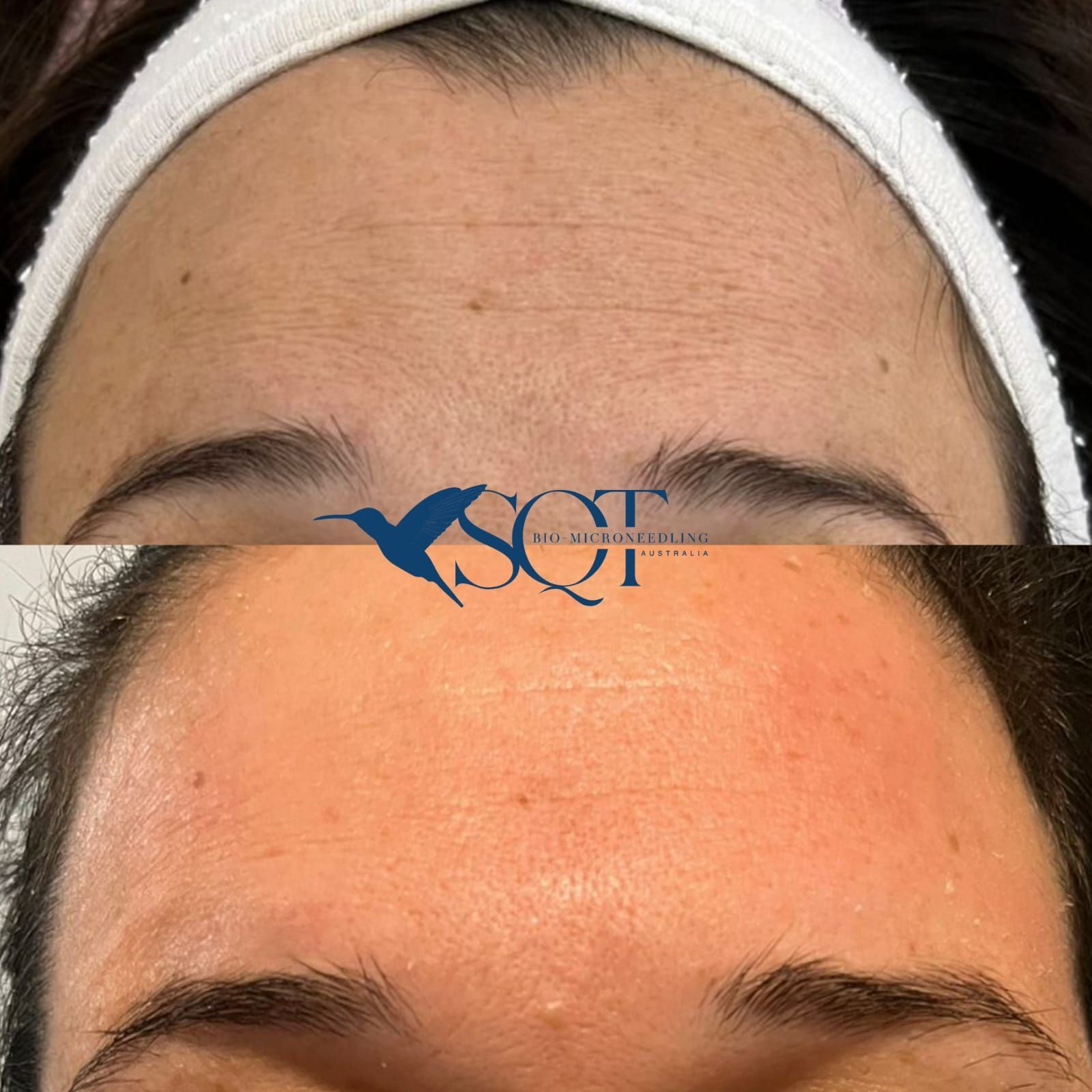 Side Profile of a Person Lying Down With Eyes Closed on a Clinic Treatment Bed — That Skin Clinic in Mooloolaba, QLD