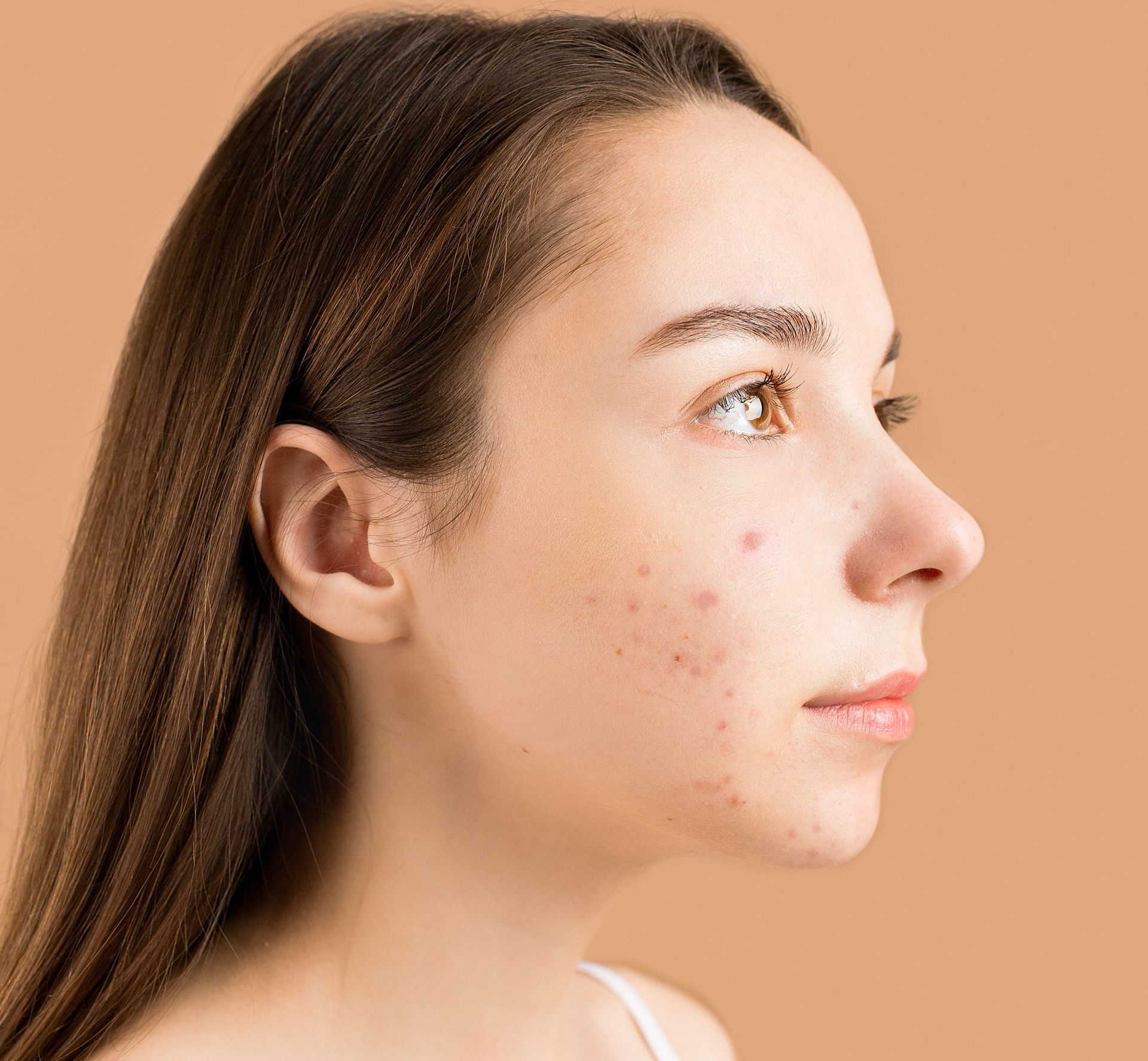 Congested Skin Treatments Sunshine Coast