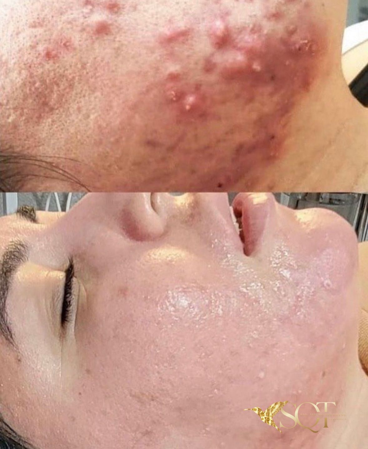 Close-up of a Cheek Before and After Treatment — That Skin Clinic in Mooloolaba, QLD