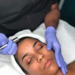 microdermabrasion
