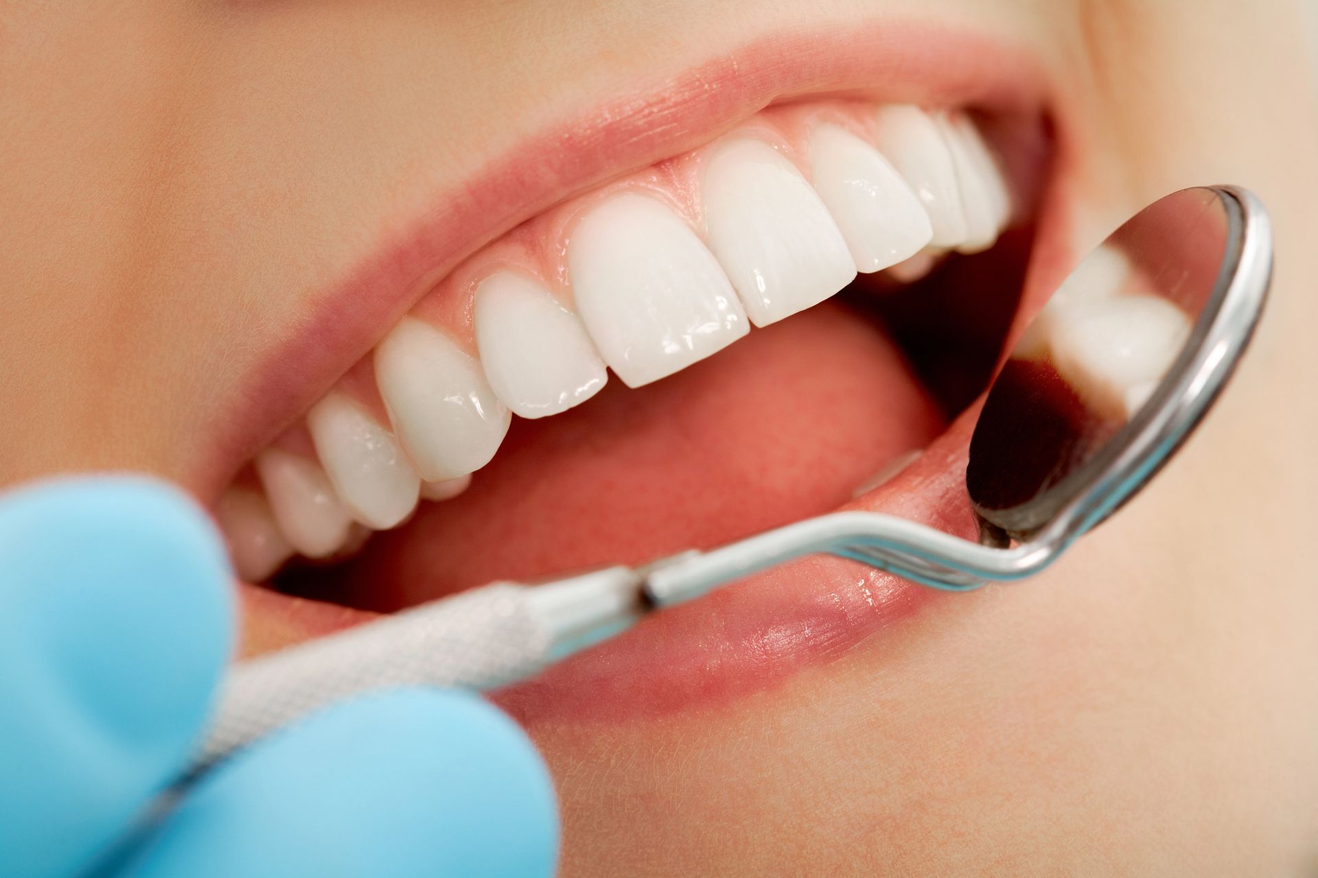 Specchietto dentale che ispeziona una bocca sorridente con denti bianchi e una mano guantata