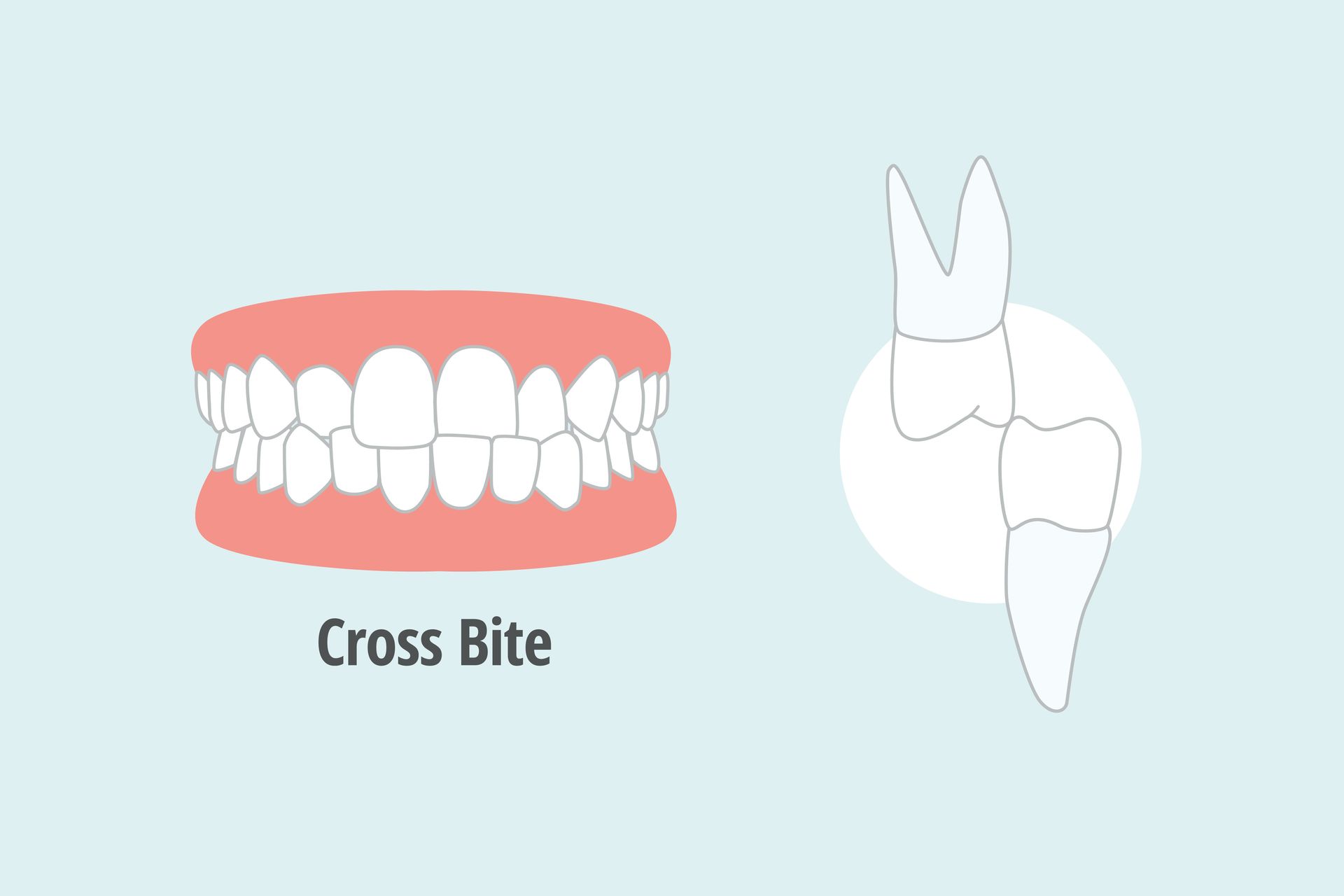 Understanding Crossbites Crossbites Treatment in Plymouth, MA