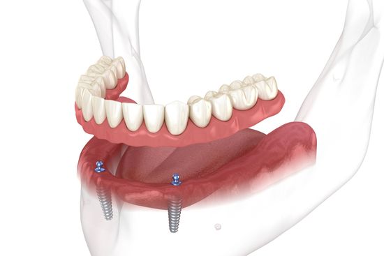 overdentures