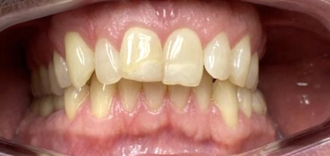 Invisalign results