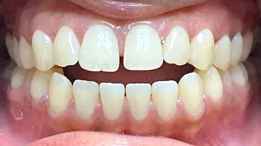 Invisalign Treatment at Plymouth Bay Dental