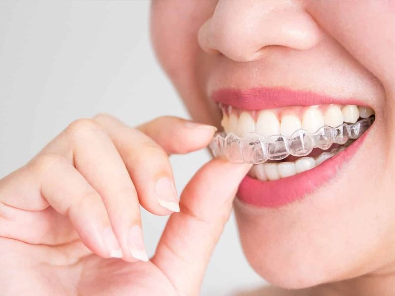 Comprehensive Guide for Invisalign Comprehensive Invisalign® Treatment in Plymouth, MA