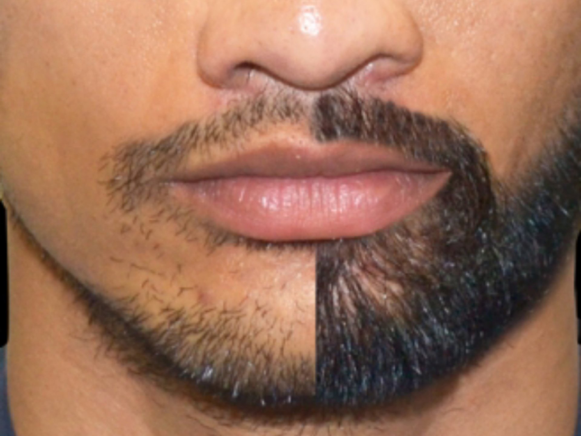 Beard Transplants In Turkey, Where? How much?