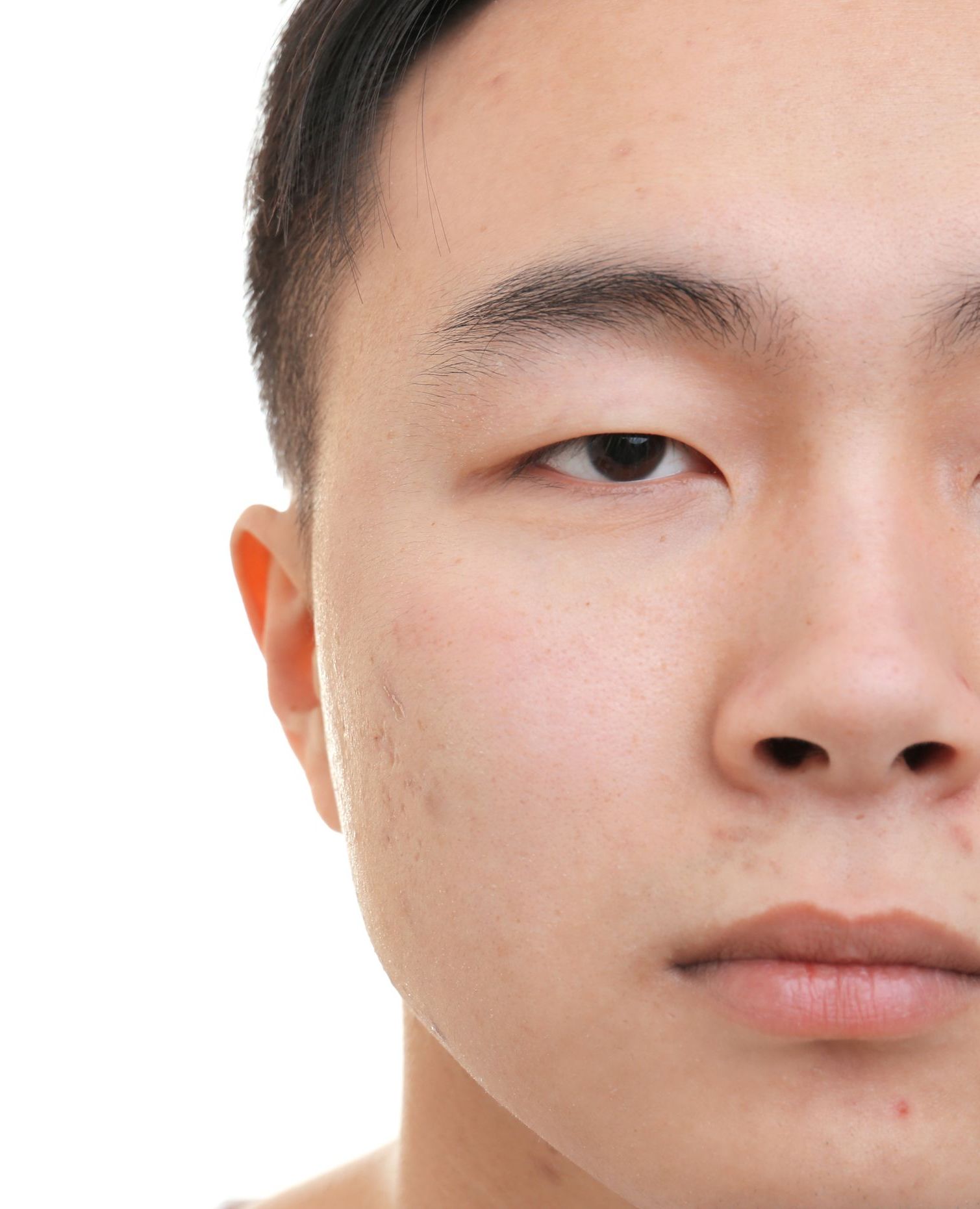 Acne Care