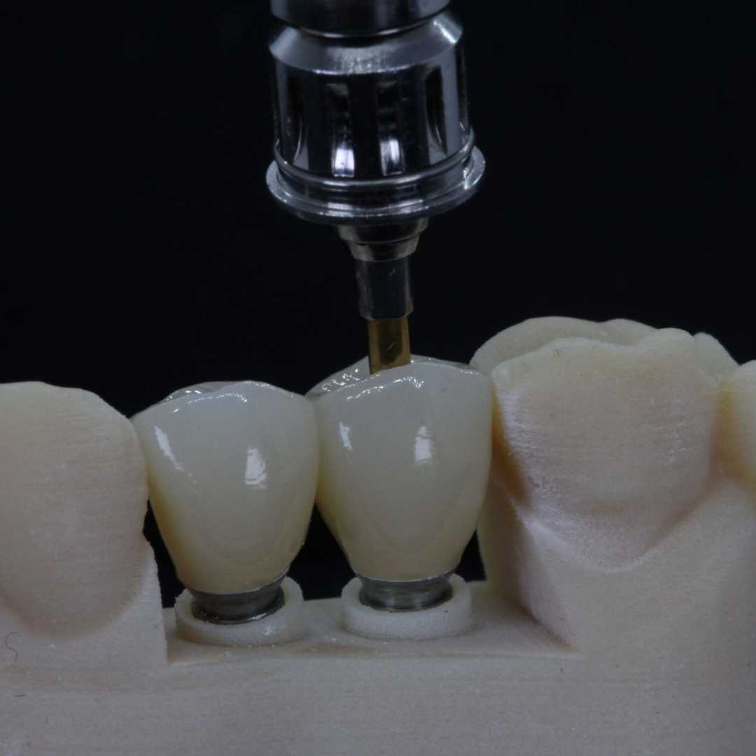 restoring dental implant with computer technology best practice near me