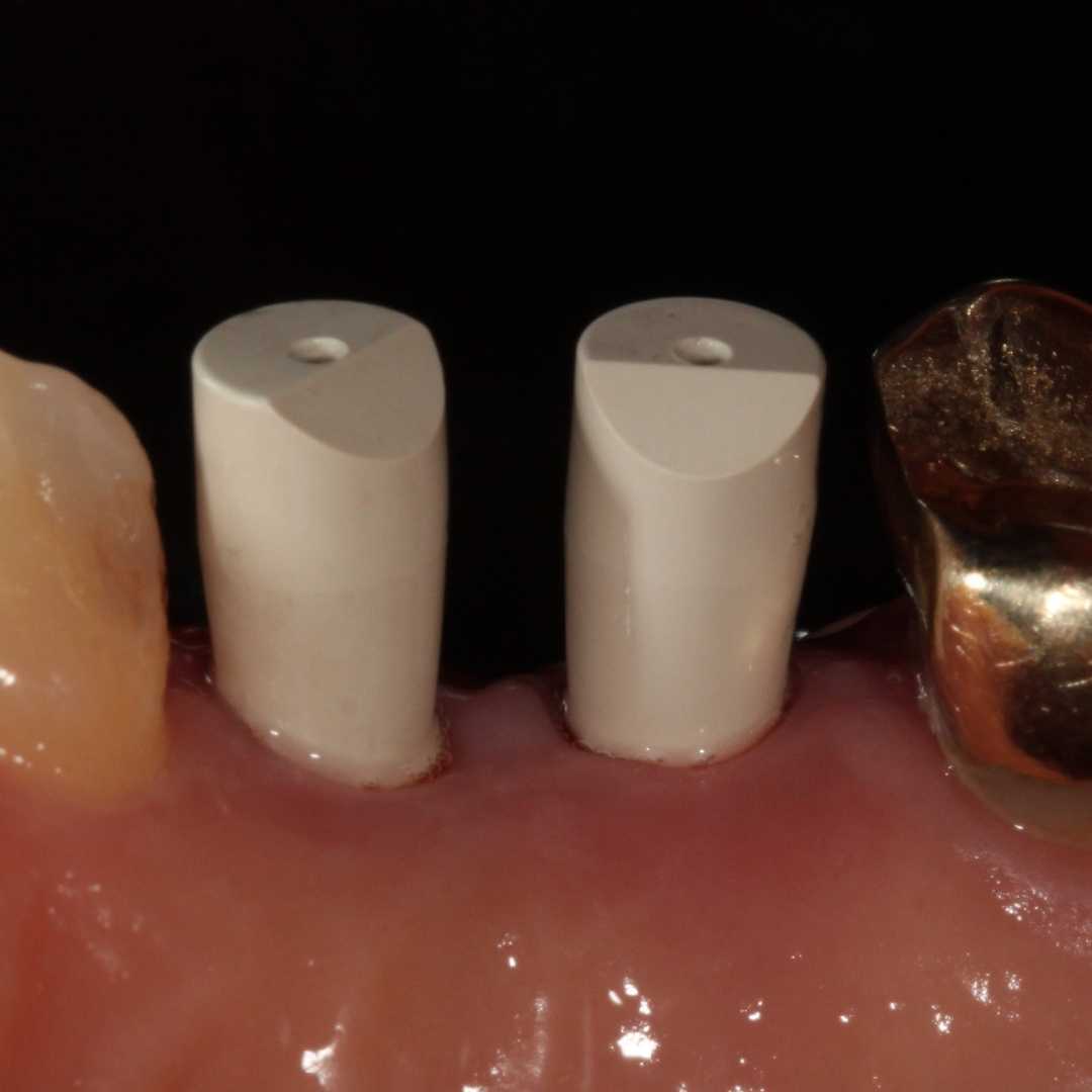 digital scanning implant restorations cost affordable near me