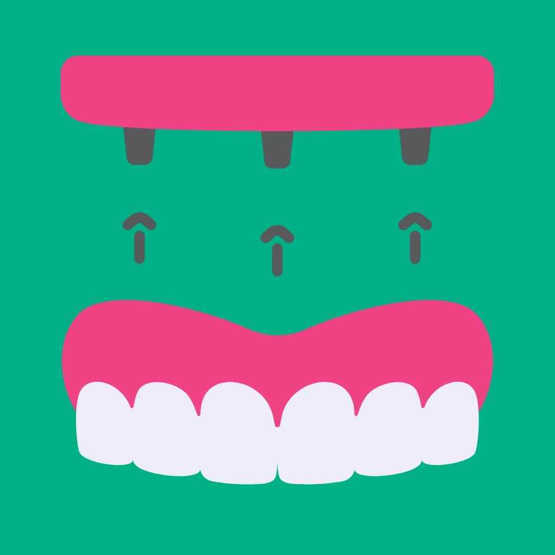 implant tooth replacement best surgeon dentist near me