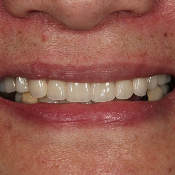 all on 4 implant full arch cost
