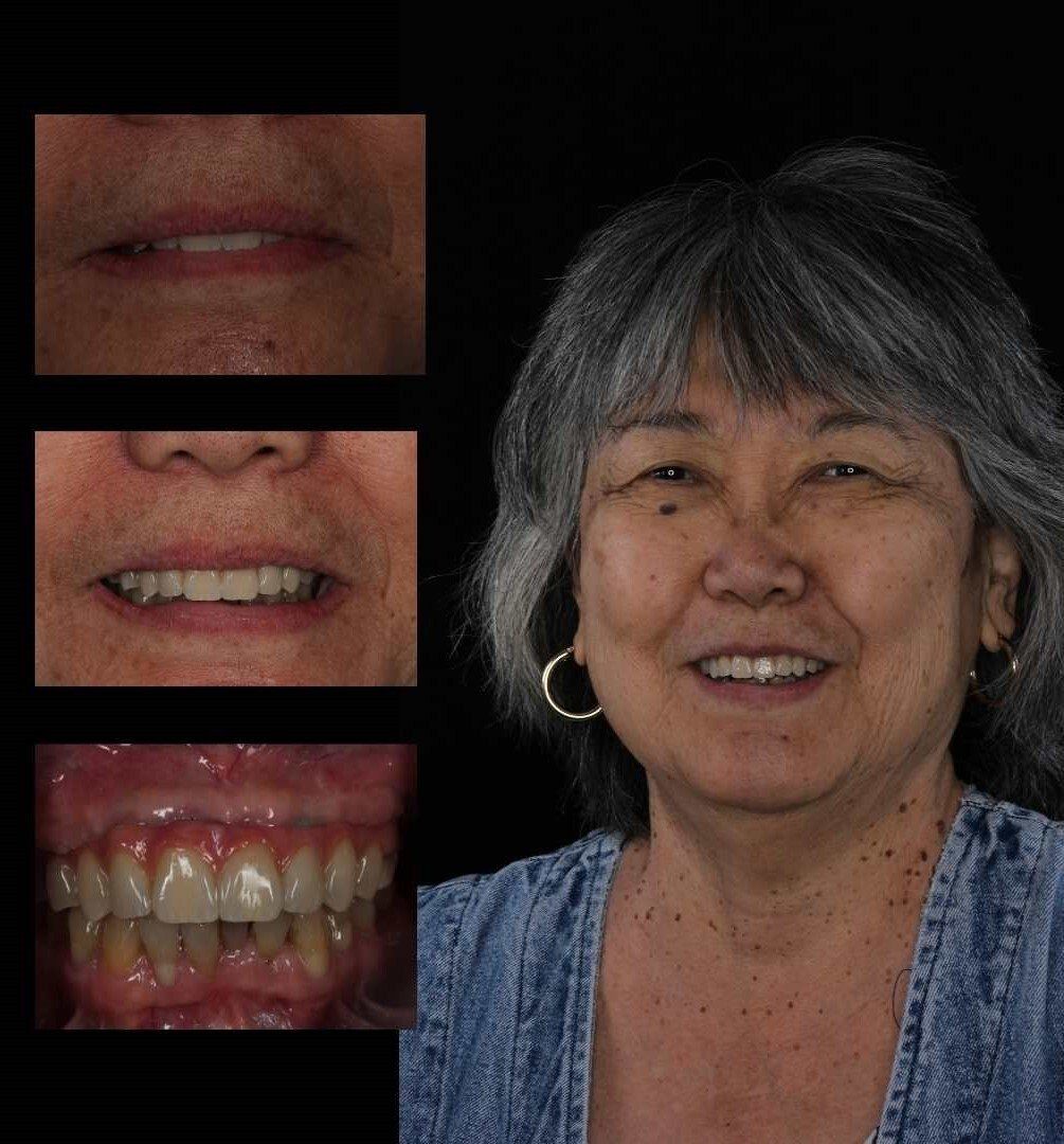 full arch all-on-4 smile implant best near me