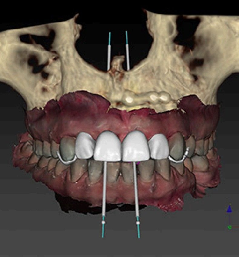 3d implant surgery
