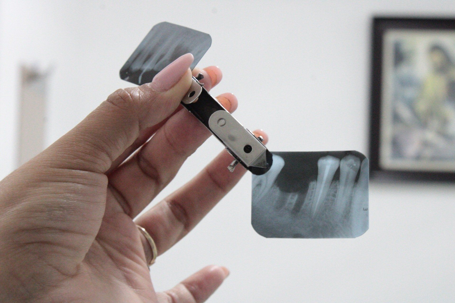 Mano sosteniendo un dispositivo médico negro y plateado con dos placas de película de rayos X adheridas.