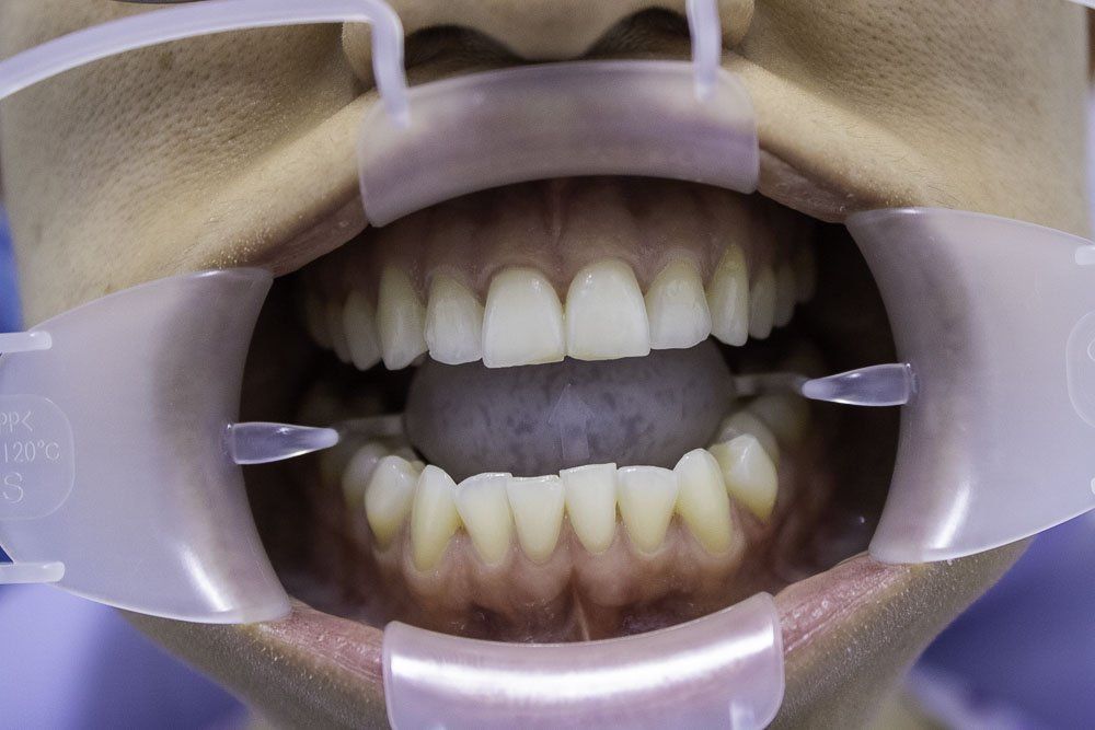 Primer plano de los dientes con un retractor dental de mejillas y encías moradas, mostrando tanto los dientes superiores como los inferiores.