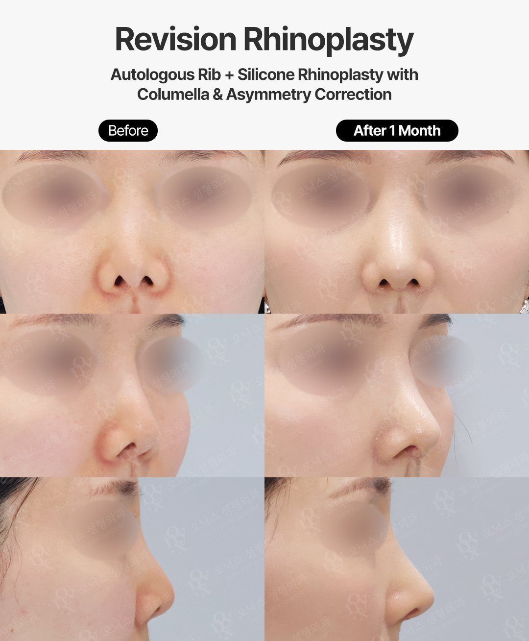 Revision rhinoplasty before and after in Korea: asymmetric tip and nostrils corrected with autologous rib cartilage and silicone, columella support rebuilt, front, oblique and side views, 1 month after surgery