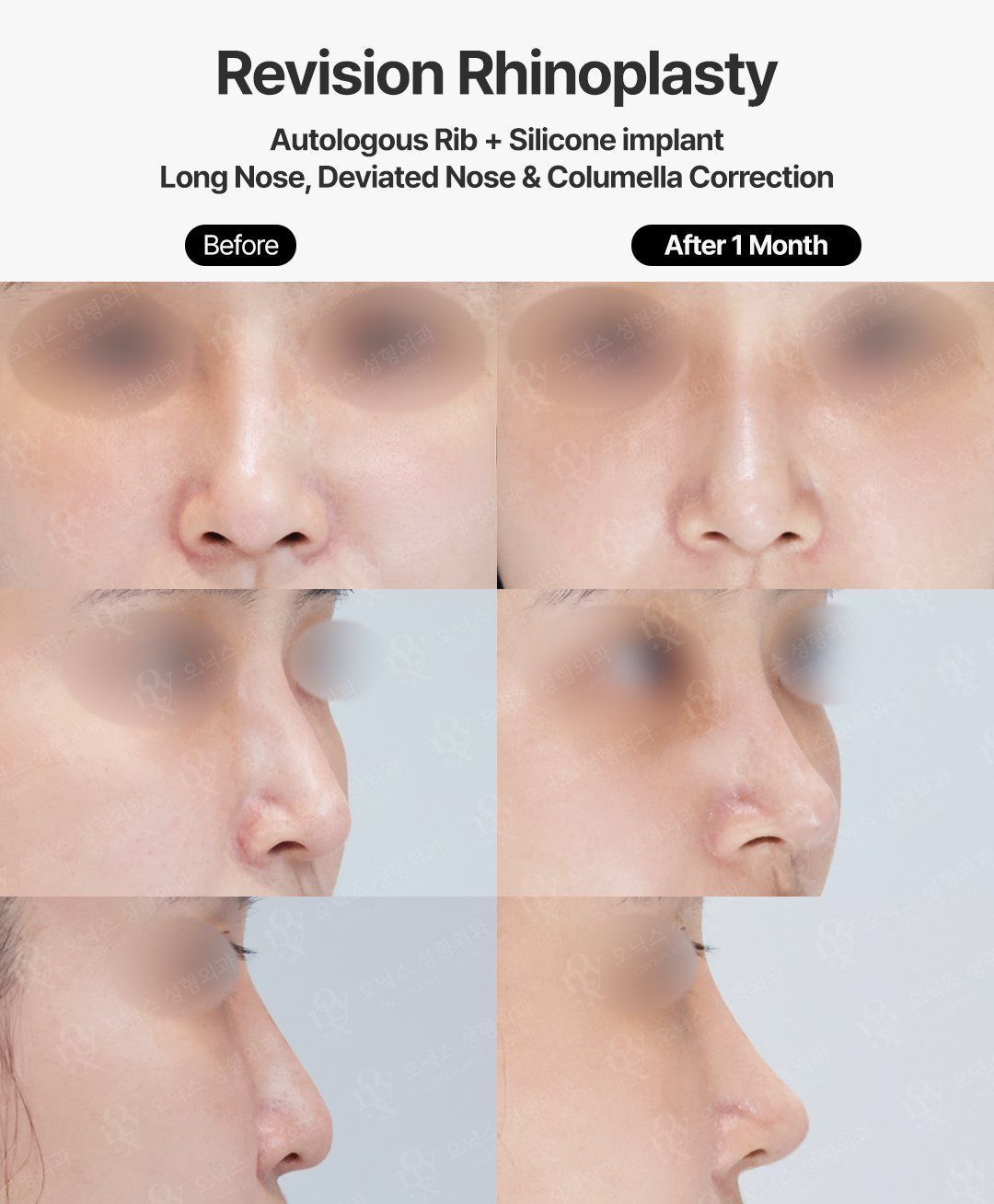 Revision rhinoplasty before and after in Korea: long, deviated nose straightened and shortened with autologous rib cartilage and silicone implant, columella corrected, 1 month after surgery