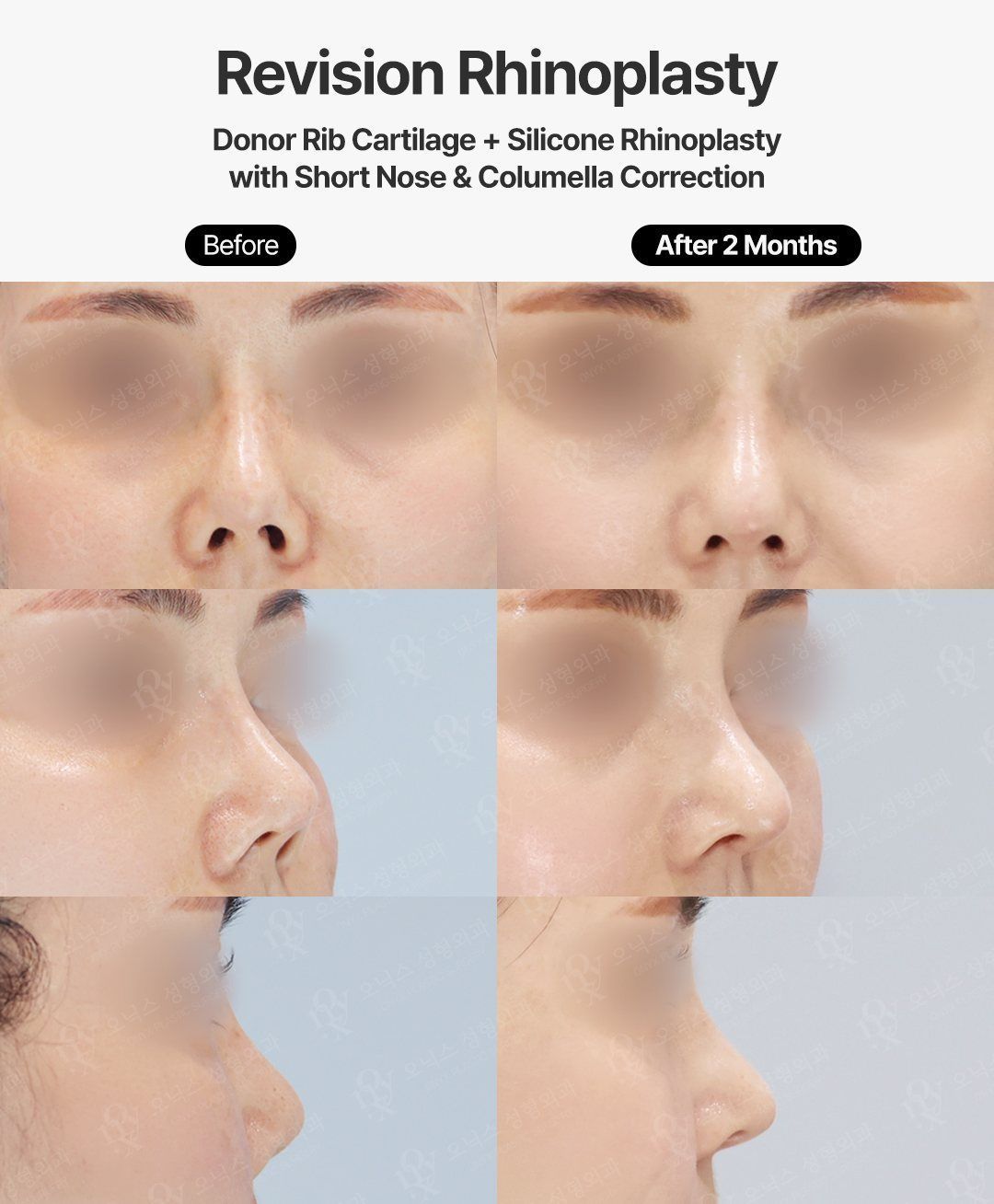 Revision rhinoplasty before and after in Korea: short, upturned nose lengthened with donor rib cartilage and silicone, columella corrected, front, oblique and profile views, 2 months after surgery
